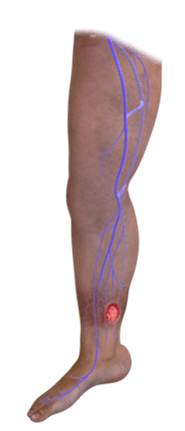 Venous leg ulcer illustration