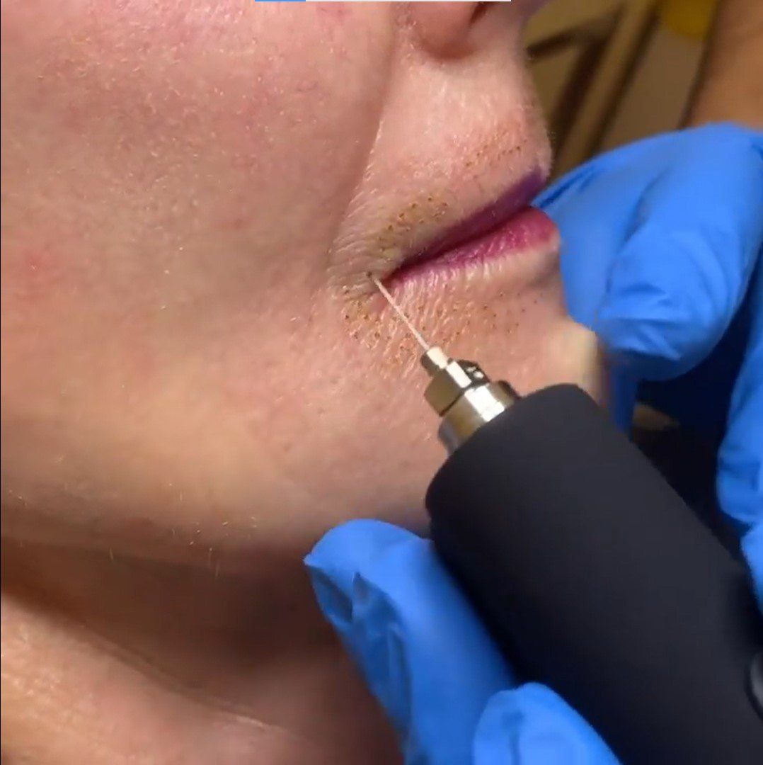 A woman is getting a botox injection in her mouth.