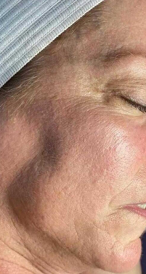 A close up of a woman 's face with a black spot on it.