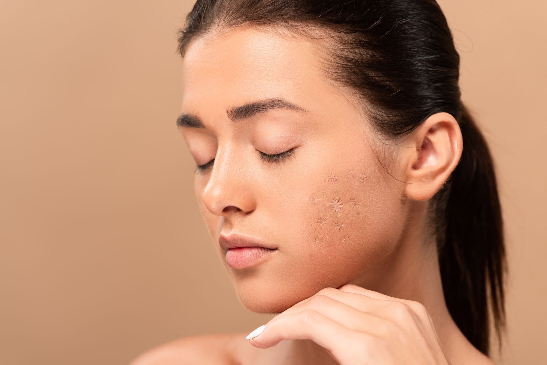 Women With Acne Scars Receiving Treatment