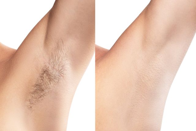 Women Underarm Hair Removal Concept Before And After Shaving Laser Stock  Photo Picture And Royalty Free Image Image 115613229