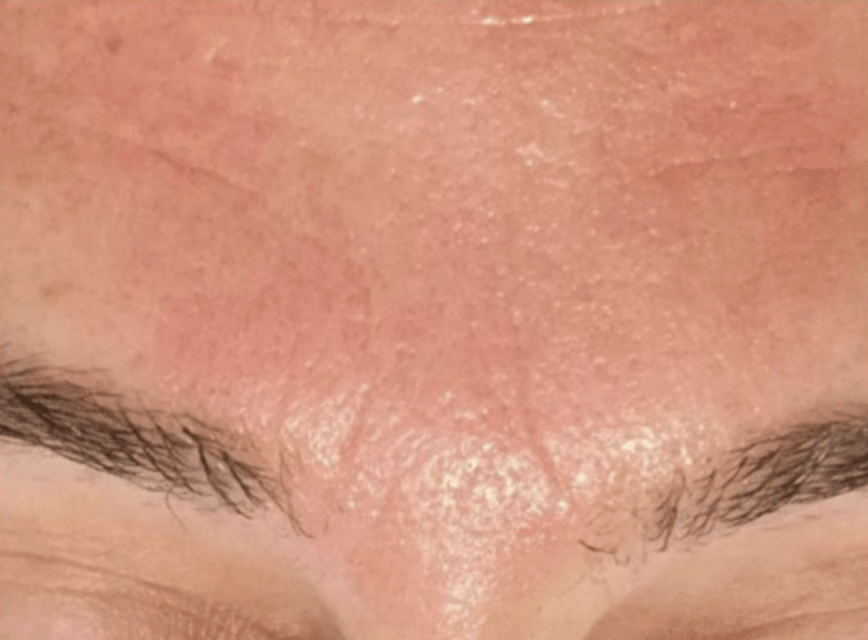 A close up of a person 's forehead and eyebrows.