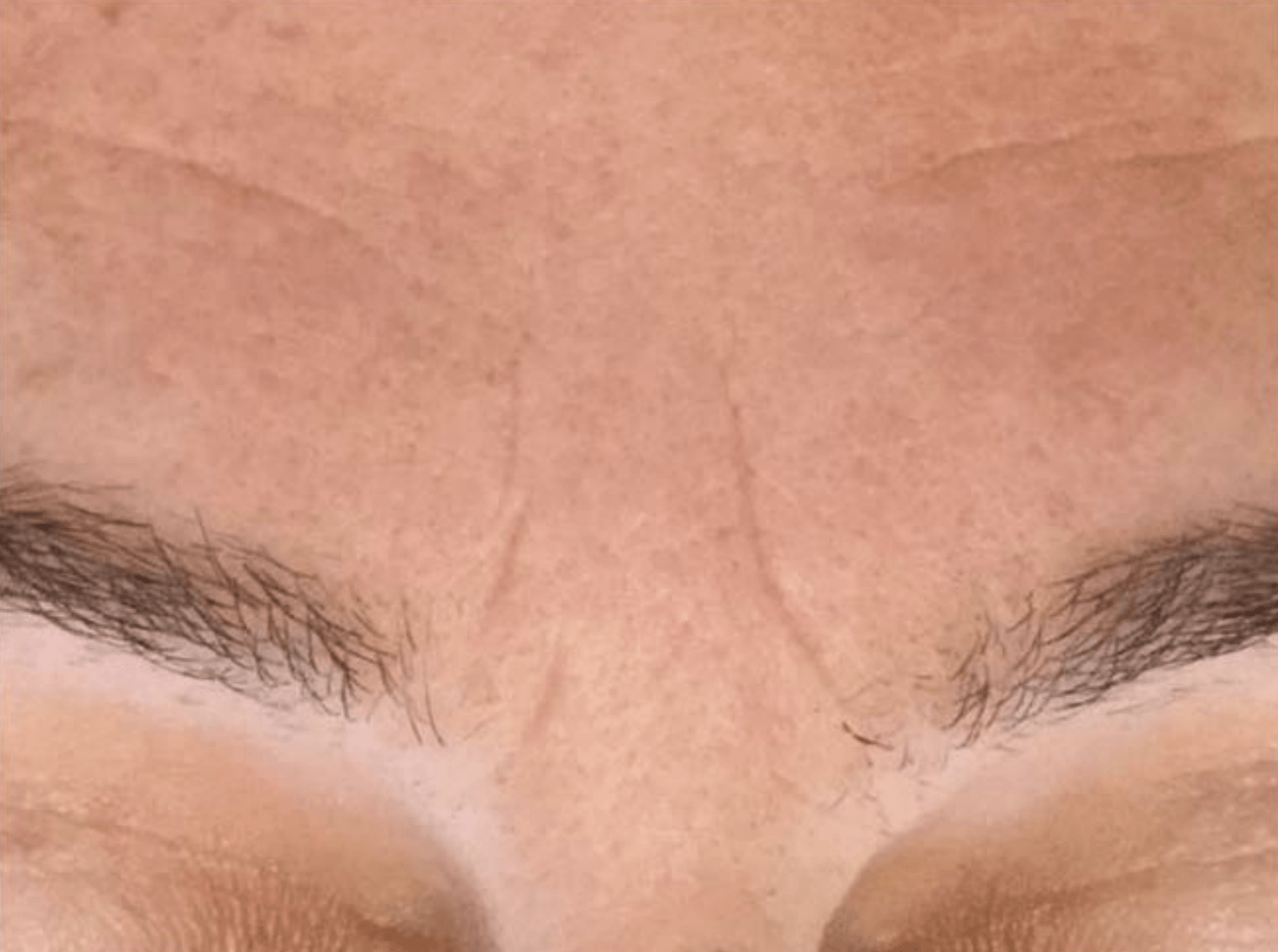 A close up of a woman 's forehead with wrinkles and eyebrows.
