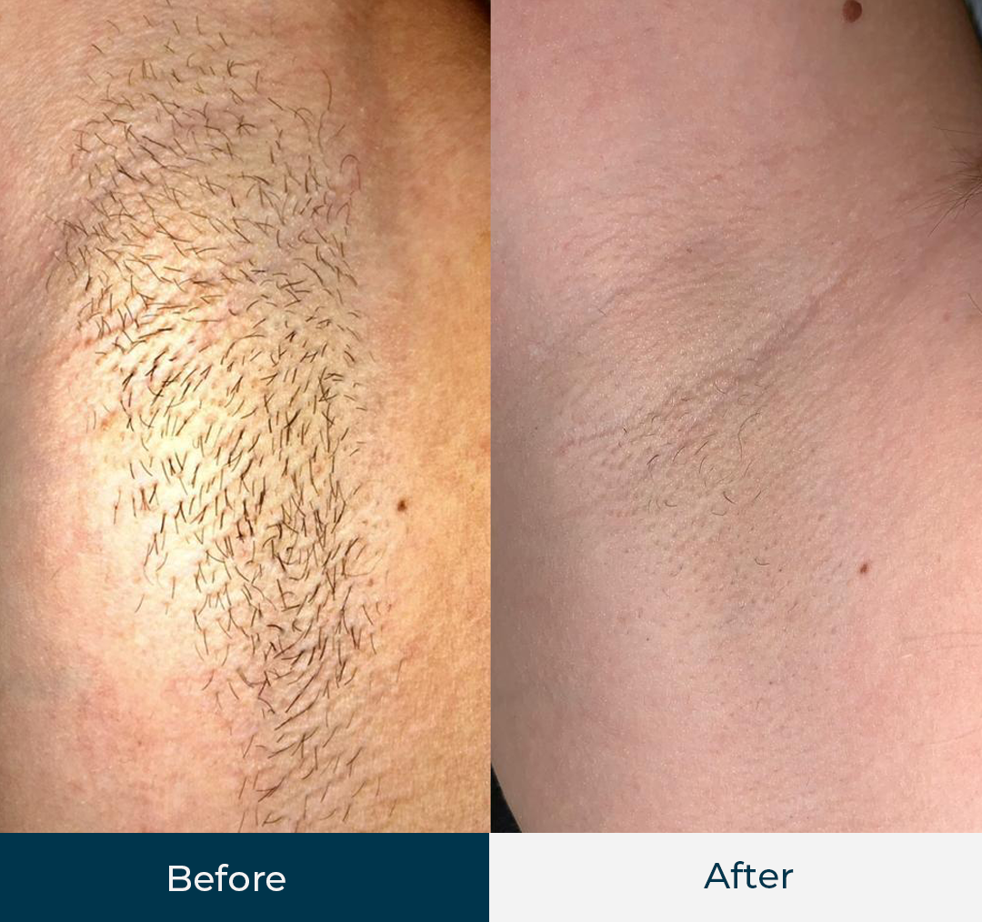 SMARTDiode laser hair removal before and afters