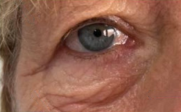 A close up of an elderly woman 's eye with a red eye.