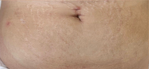 A close up of a person 's stomach with stretch marks.