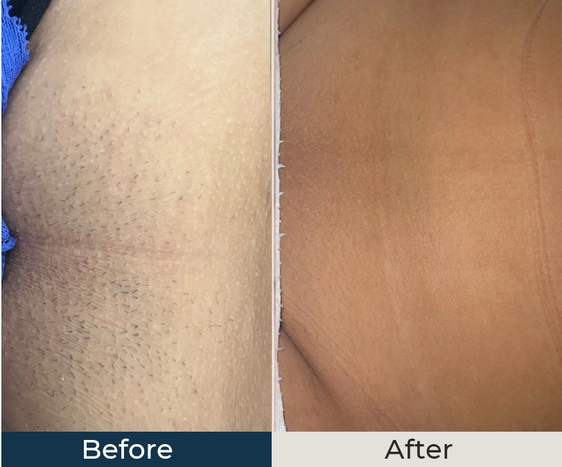 SMARTDiode laser hair removal before and afters