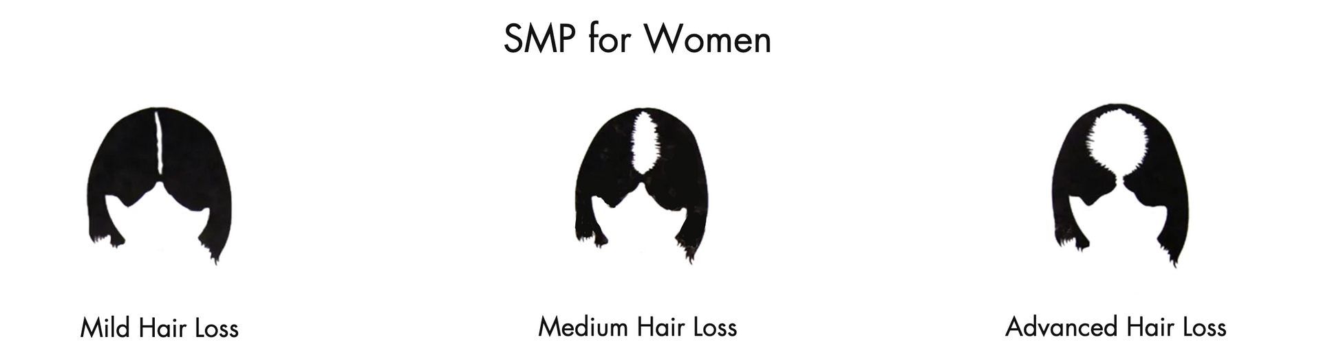 Three different types of hair loss are shown on a white background