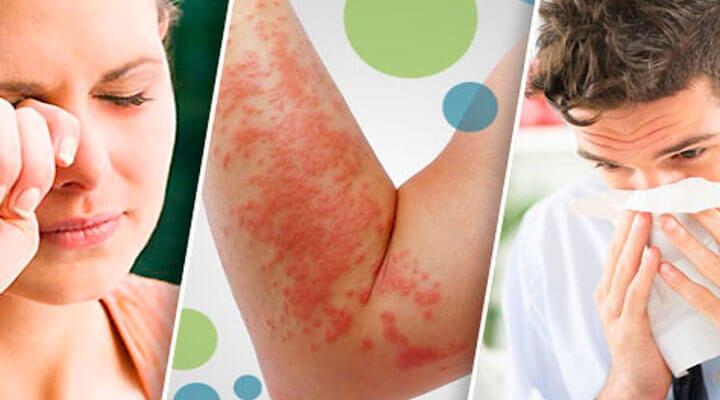 DR. RICARDO ÁLVAREZ VEGA - SINTOMAS-DE-ALERGIAS