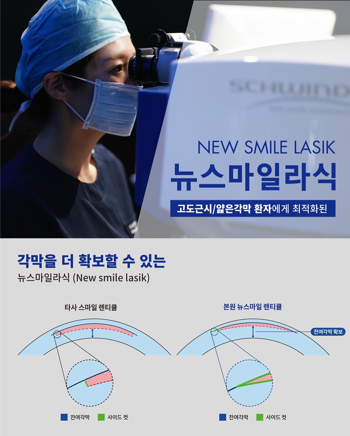 뉴스마일라식_강남스마일라식