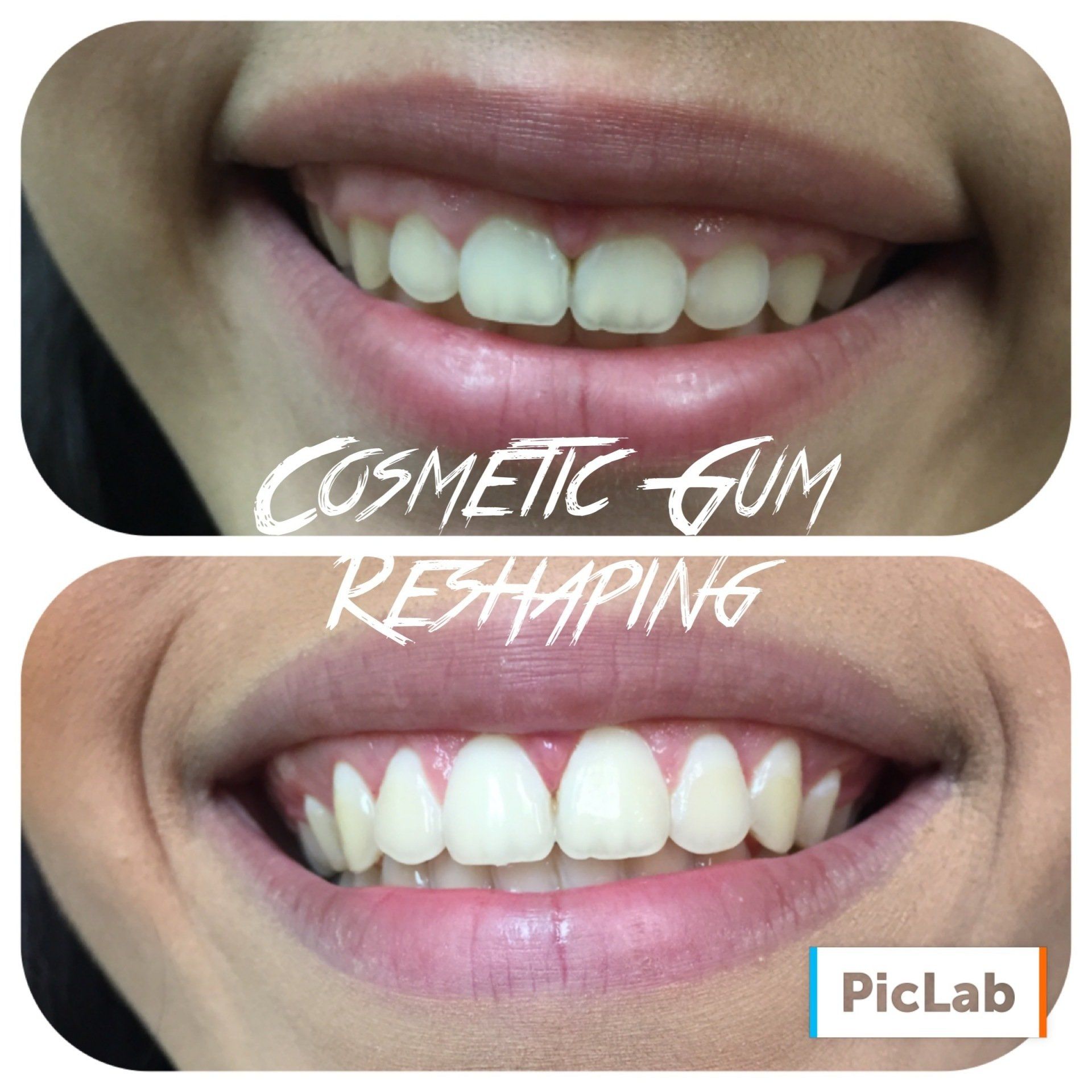 Cosmetic Gum Shaping Before & After