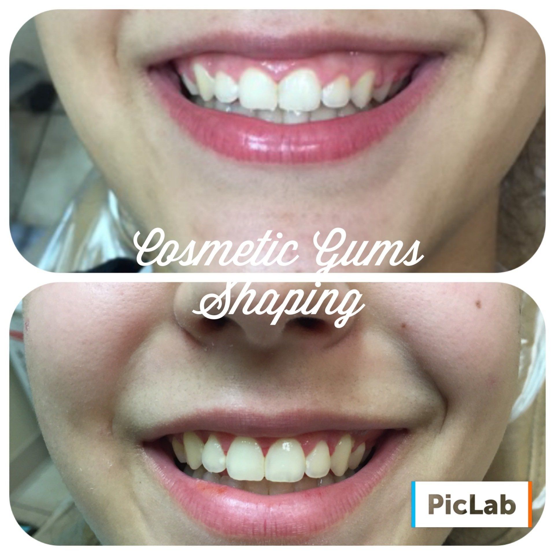 Cosmetic Gum Shaping Results