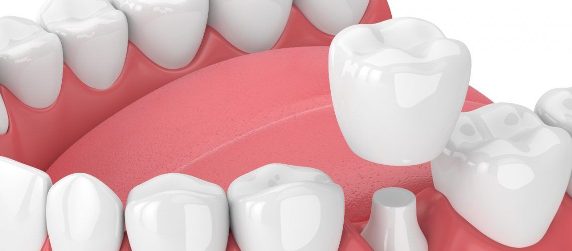 animated image of teeth with dental crown 