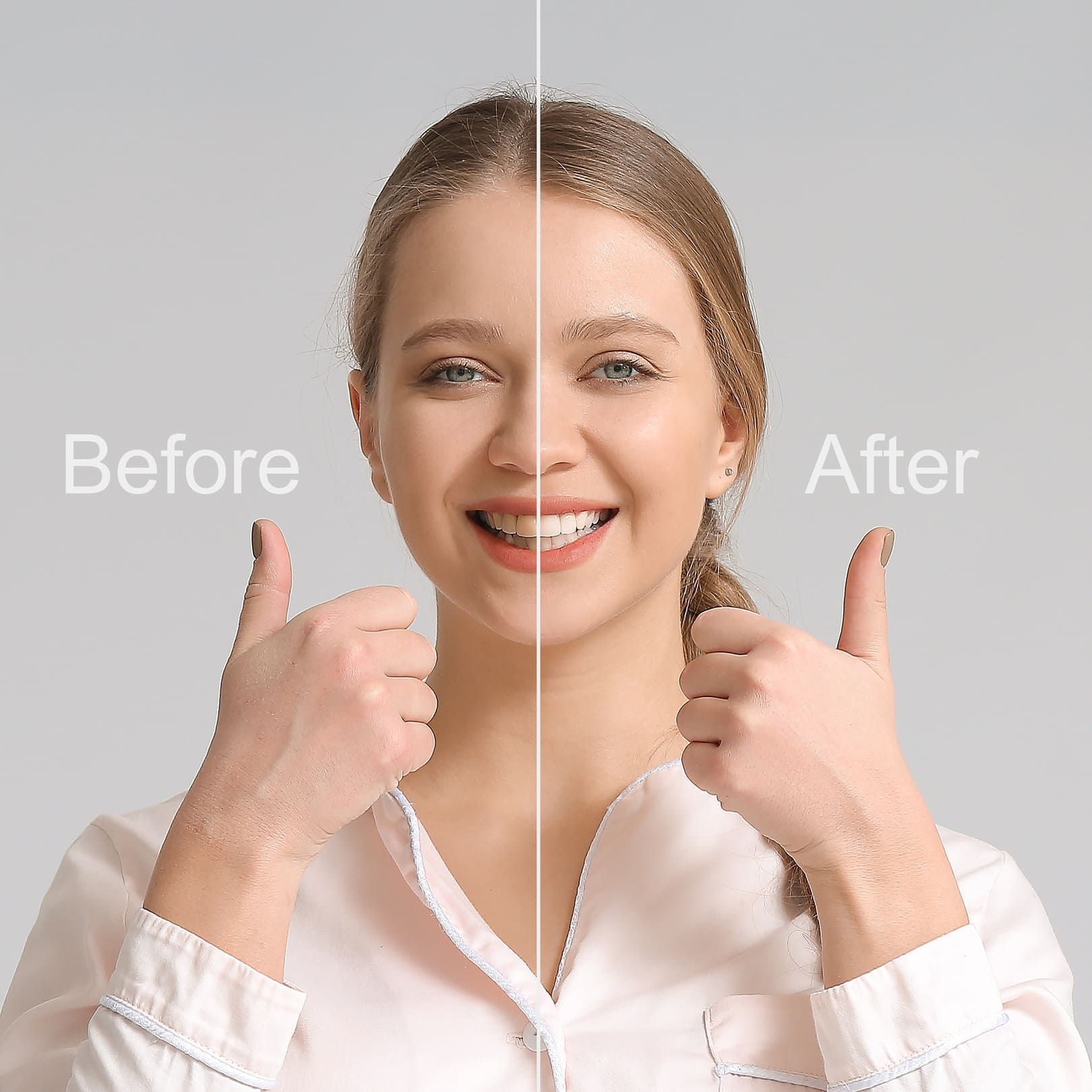 Before and after teeth whitening Prosper TX 75078