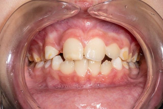 Occlusal Adjustment | 380 Family Dentistry