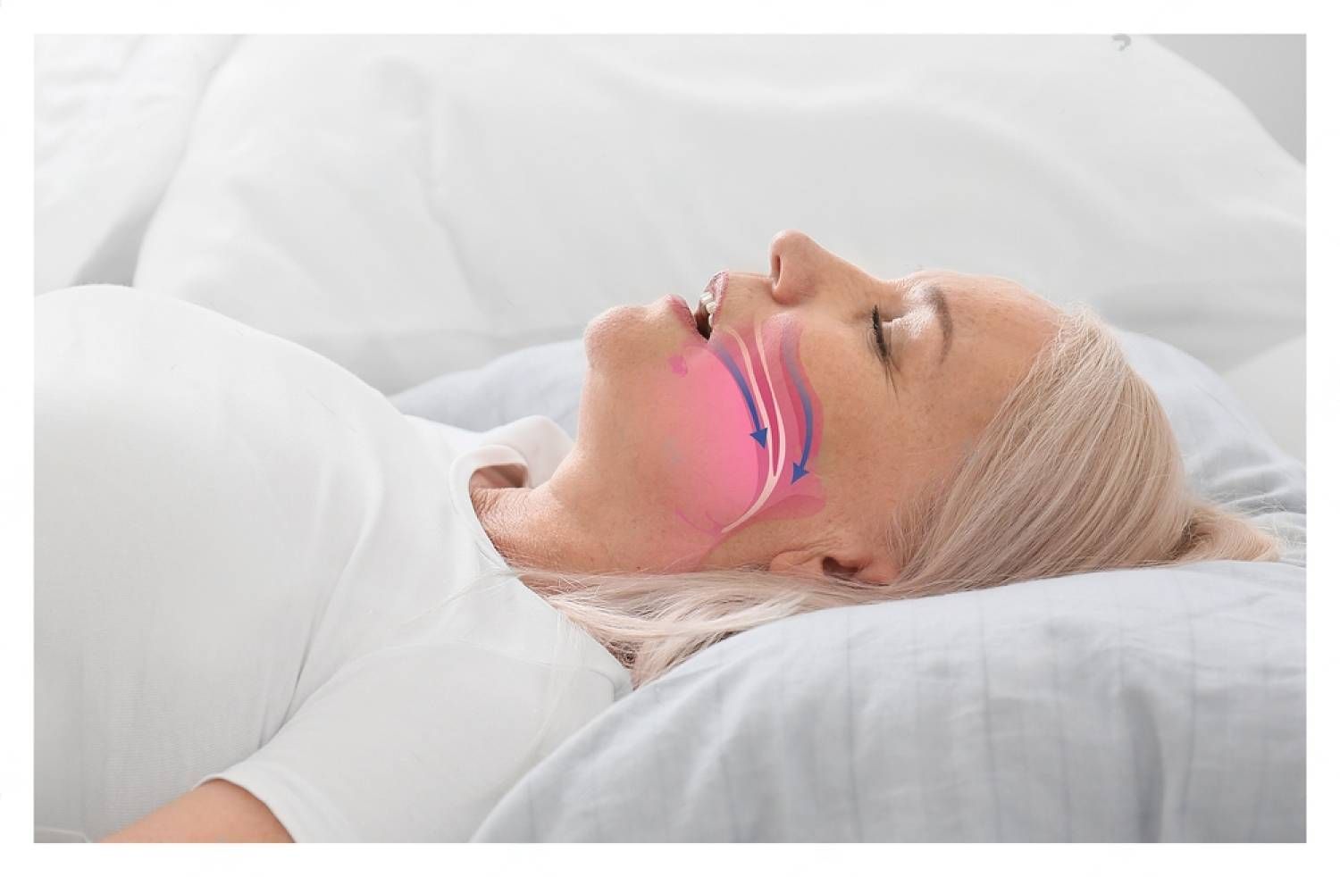 obstructive sleep apnea?