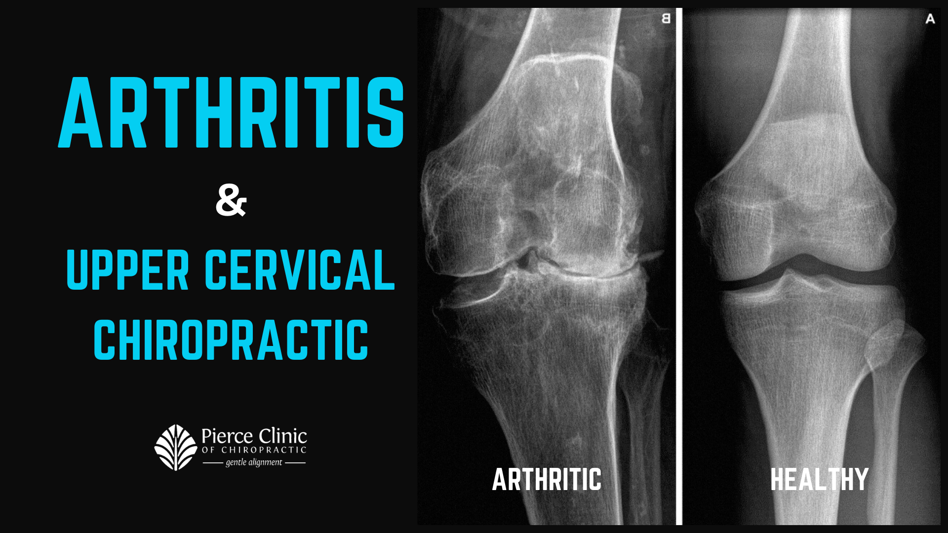 Arthritis — St. Peterburg, FL — Pierce Clinic of Chiropractic