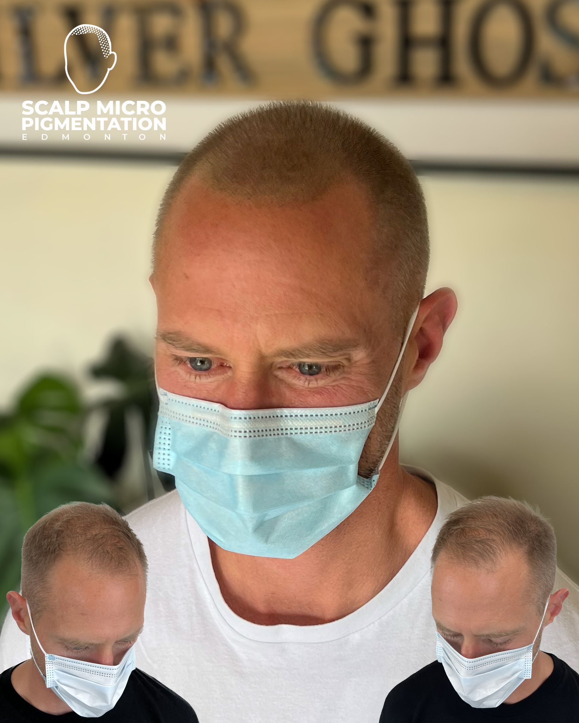 Scalp Micro Pigmentation Treatments Overcome Hair Loss scalp-micro-pigmentation-treatments-overcome-hair-loss