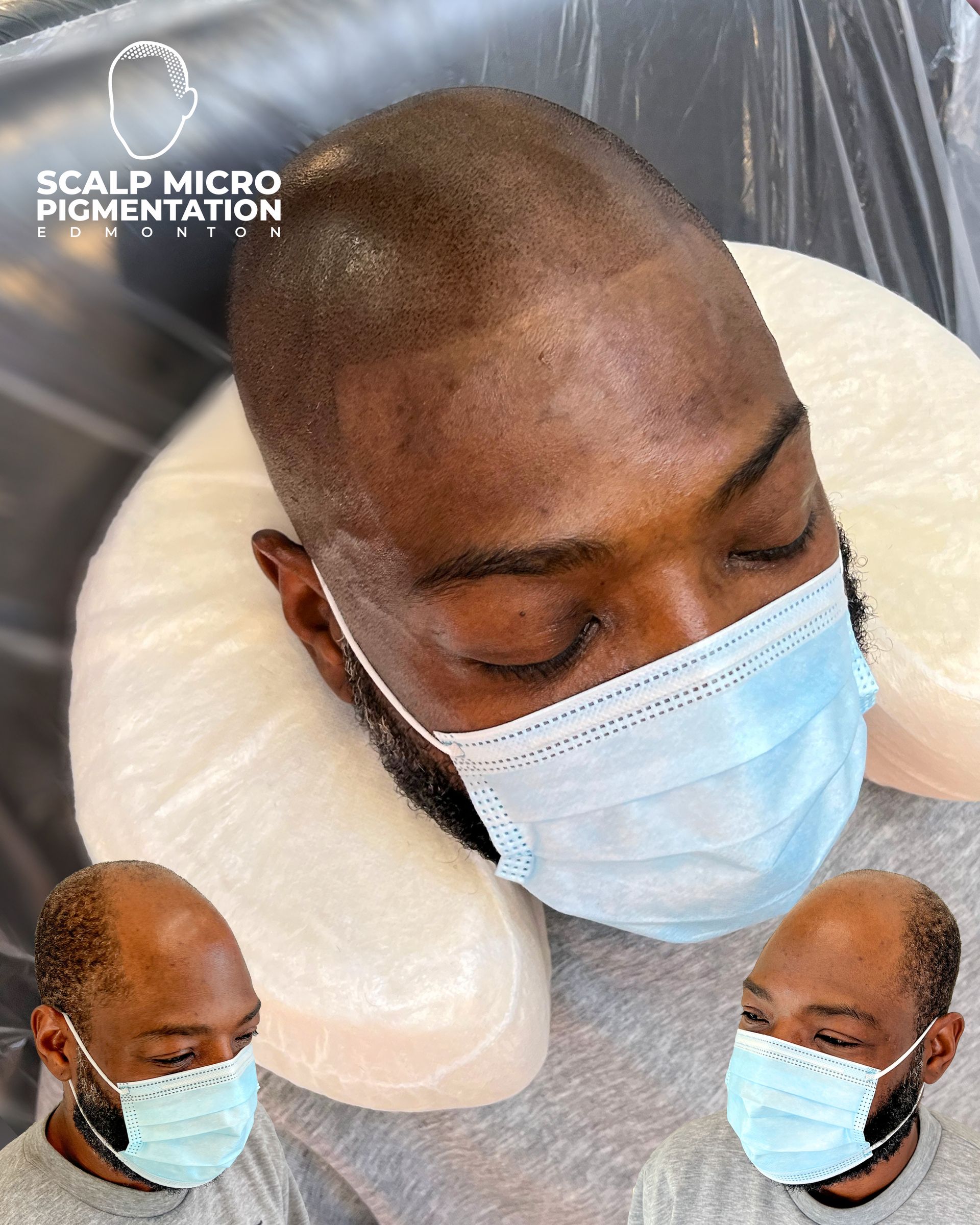 Male Client M72 | Scalp Micropigmentation | Edmonton