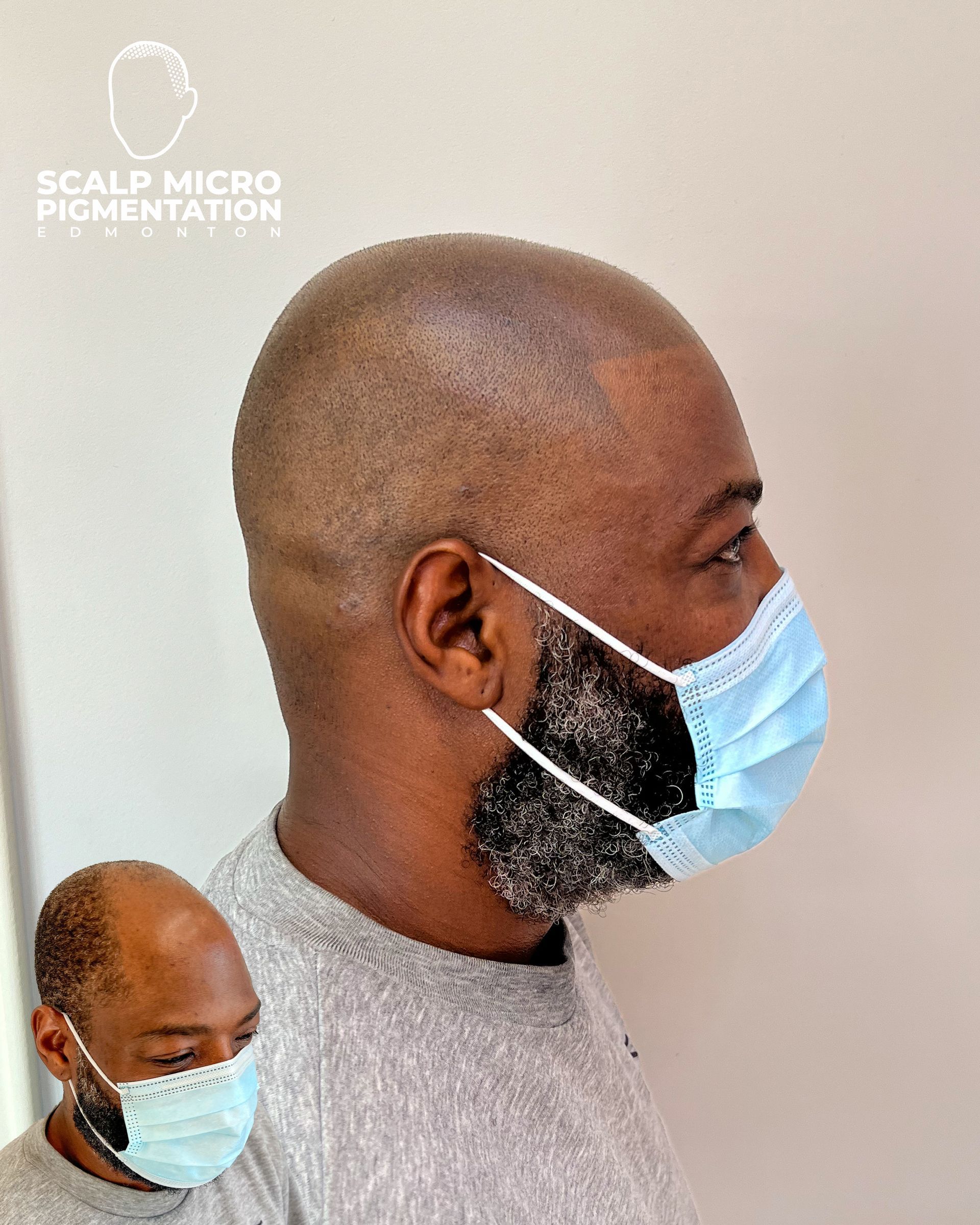 Male Client M72 | Scalp Micropigmentation | Edmonton