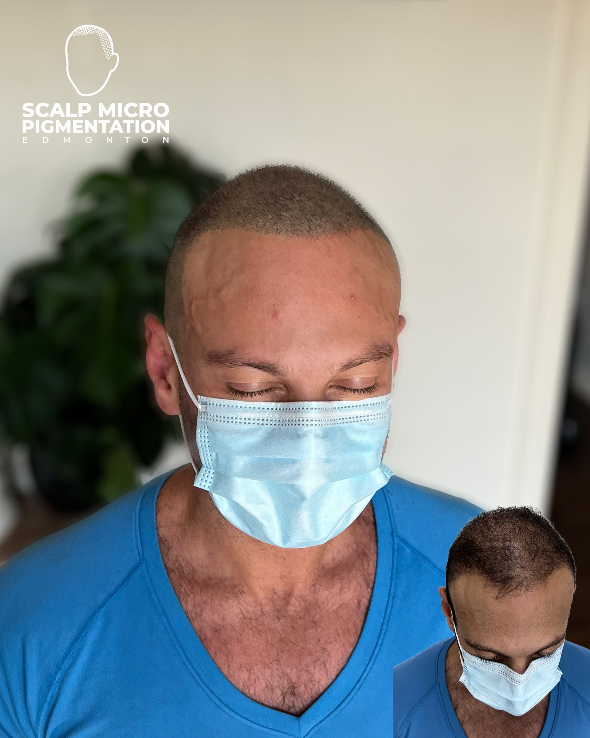 Scalp Micro Pigmentation Treatments Hair Loss