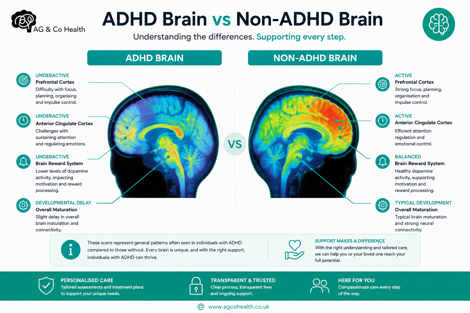 the adhd brain vs non adhd brain graphic