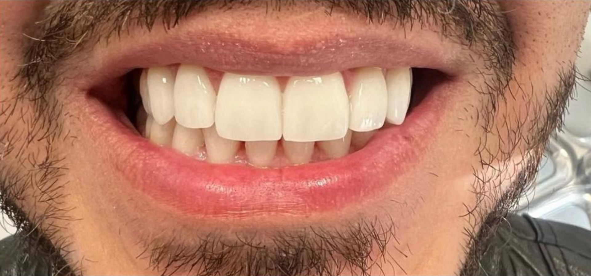 Un primo piano della bocca con denti perfetti grazie alle faccette 1 - Arte Dentale Frosinone