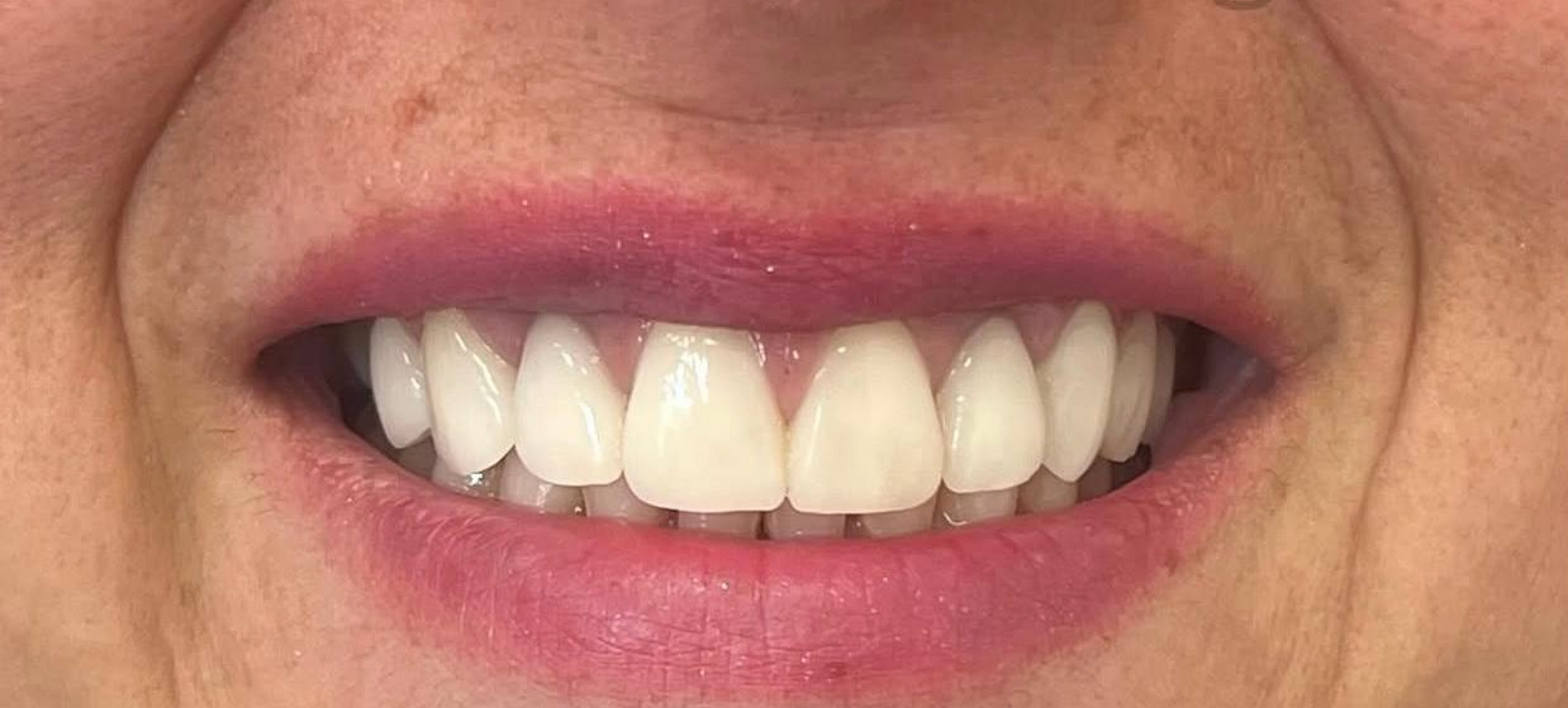 Primo piano di una bocca sorridente con denti bianchi ricoperti di faccette - arte dentale frosinone