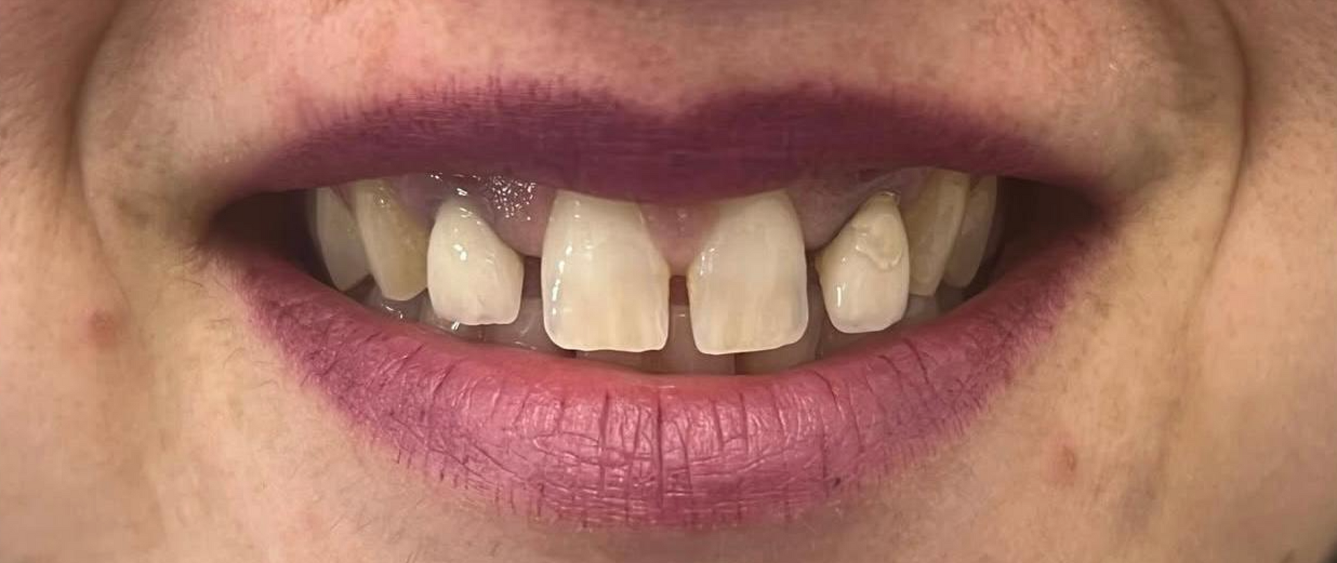 Primo piano di una bocca sorridente con denti prima delle faccette - arte dentale frosinone