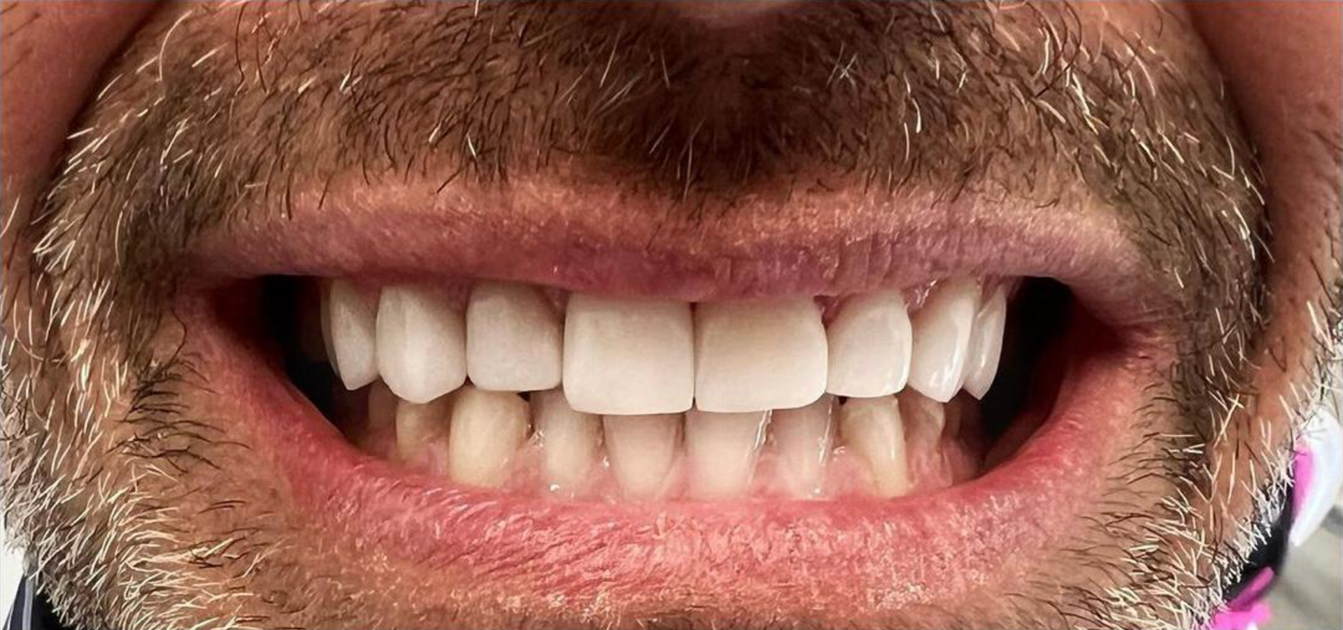 Un primo piano della bocca con denti perfetti grazie alle faccette 1 - Arte Dentale Frosinone