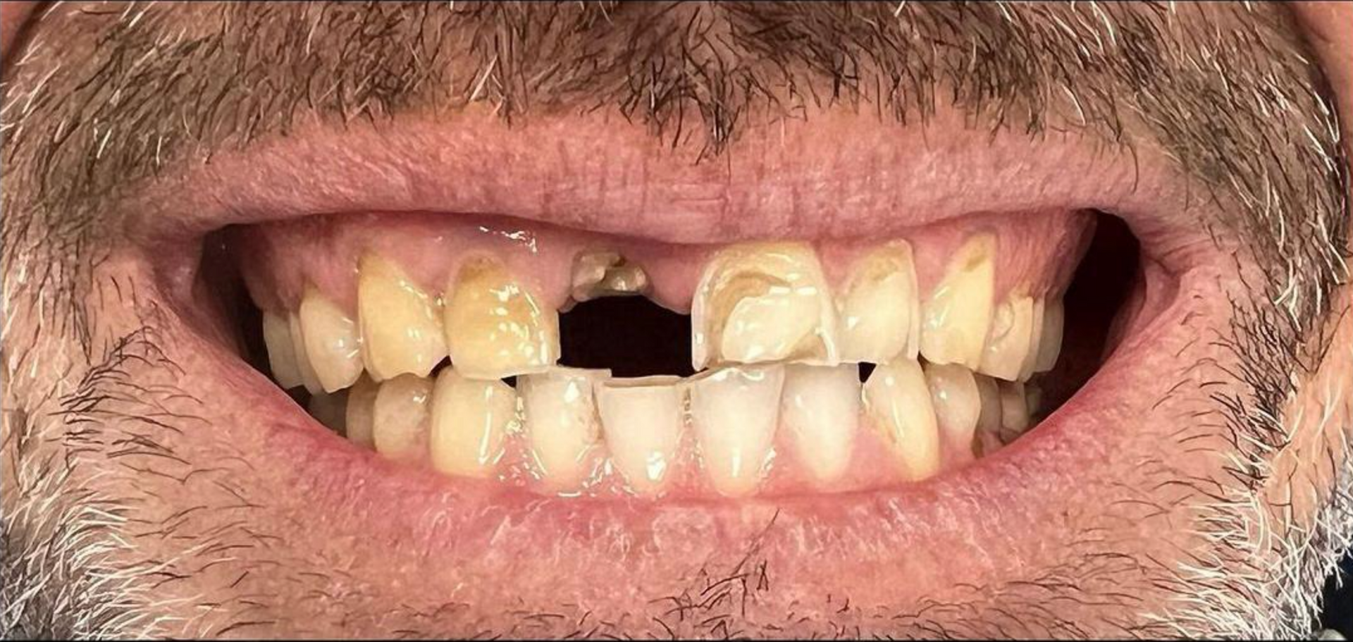 Un primo piano della bocca di un uomo con barba e denti rovinati 1 - Arte Dentale Frosinone