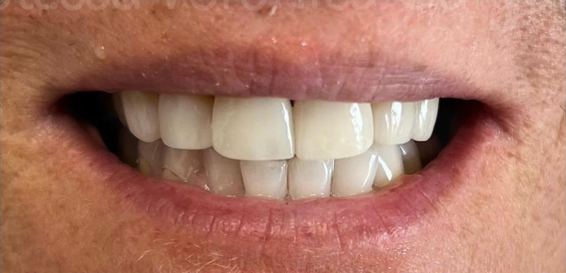Un primo piano della bocca di un uomo con barba e denti perfetti grazie alle faccette - Arte Dentale Frosinone