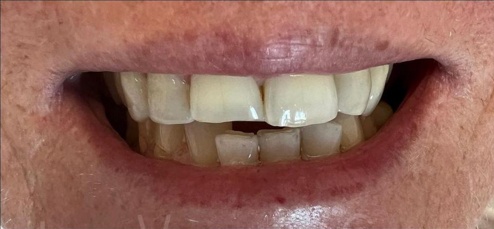 Un primo piano della bocca di un uomo con la barba e i denti rovinati - Arte Dentale Frosinone