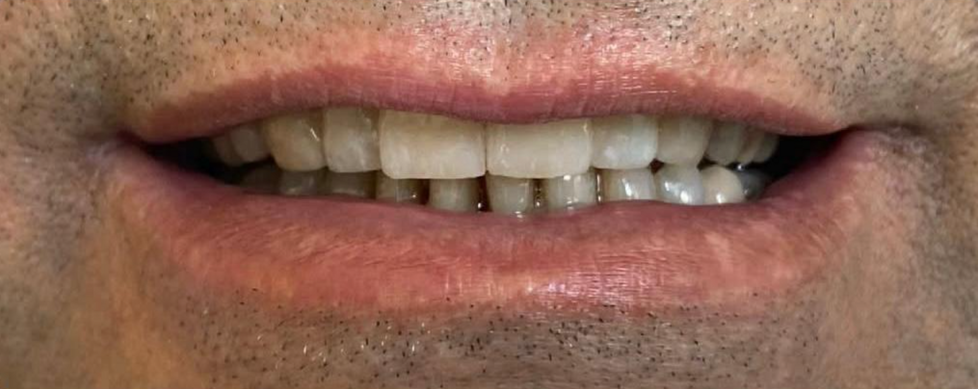 Un primo piano della bocca con denti perfetti grazie alle faccette 1 - Arte Dentale Frosinone