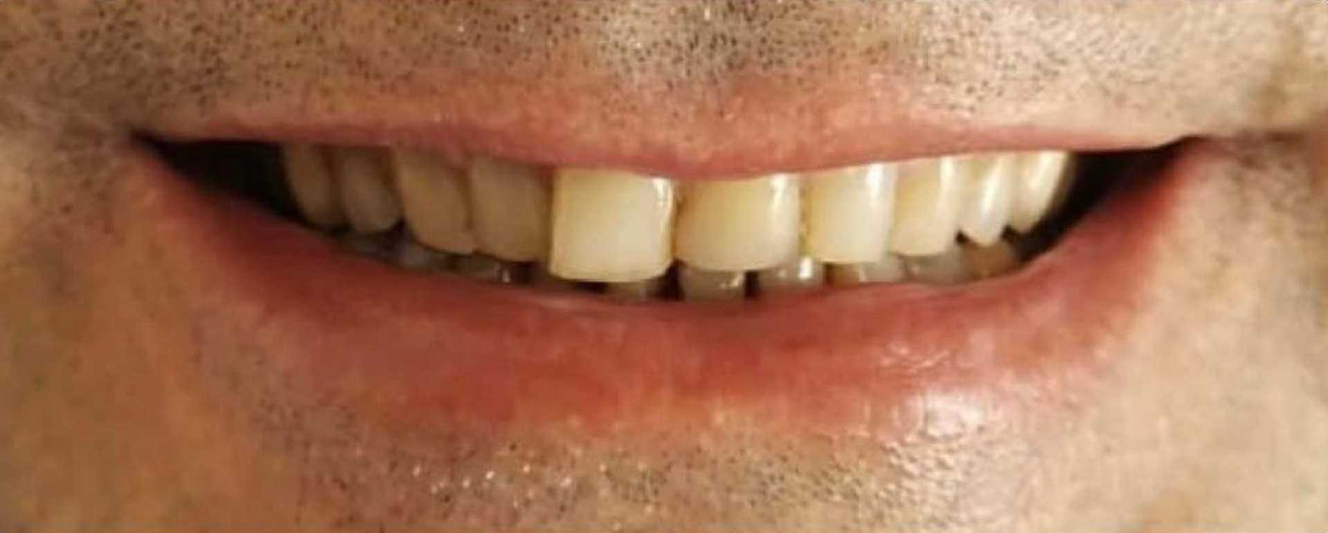 Un primo piano della bocca di un uomo con barba e denti rovinati 1 - Arte Dentale Frosinone