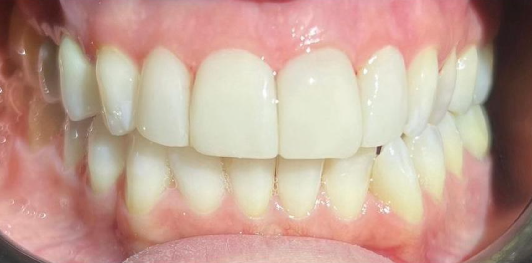 Primo piano della bocca di una persona con un sorriso luminoso che mette in mostra i denti bianchi.