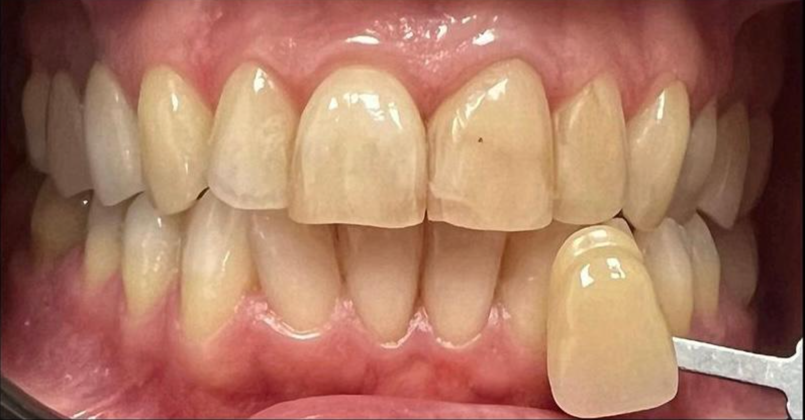 Primo piano della bocca sorridente di una persona che mostra i denti, con gengive e labbra visibili.