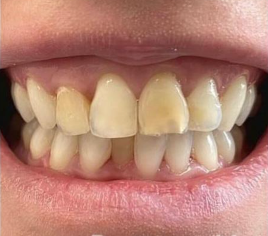 Un primo piano della bocca di un uomo con barba e denti rovinati 1 - Arte Dentale Frosinone