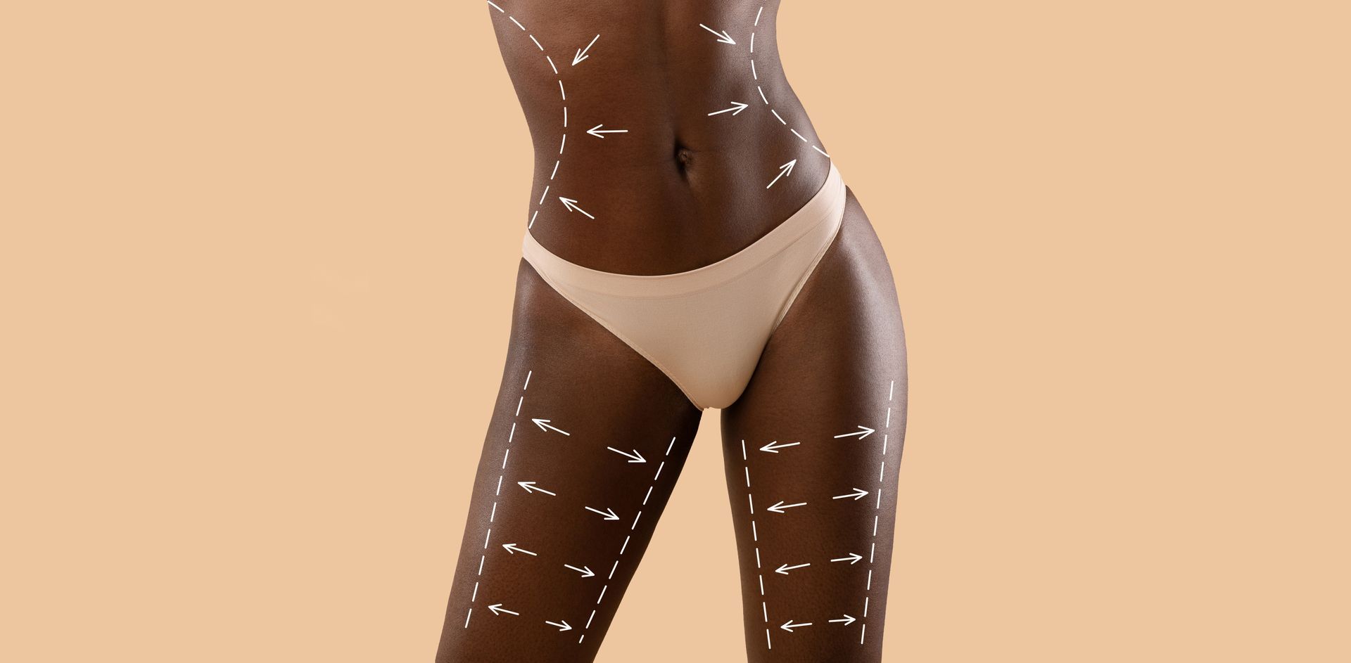 A woman in white underwear has lines drawn on her stomach and legs.