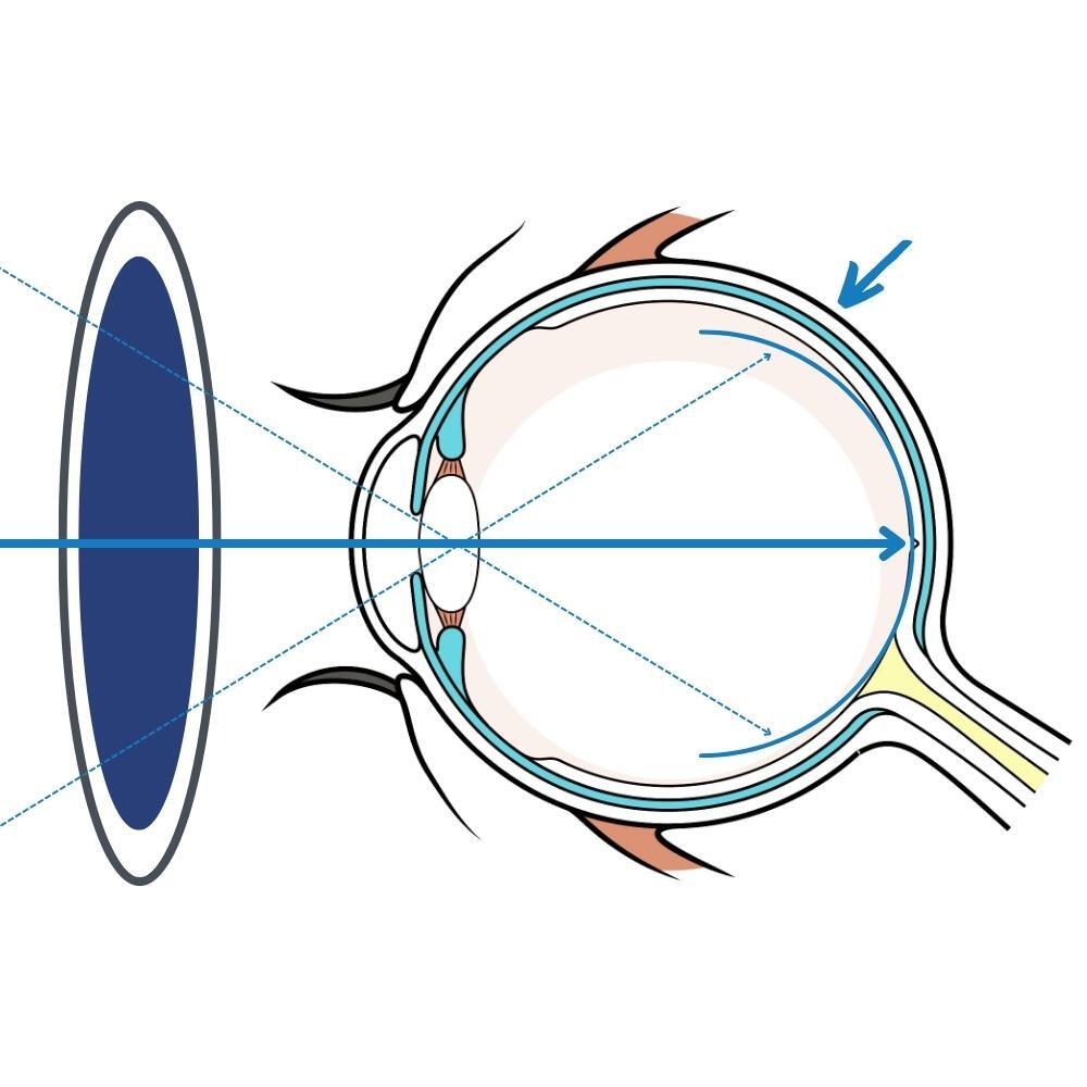 Ein Diagramm eines menschlichen Auges mit einem blauen Kreis in der Mitte.