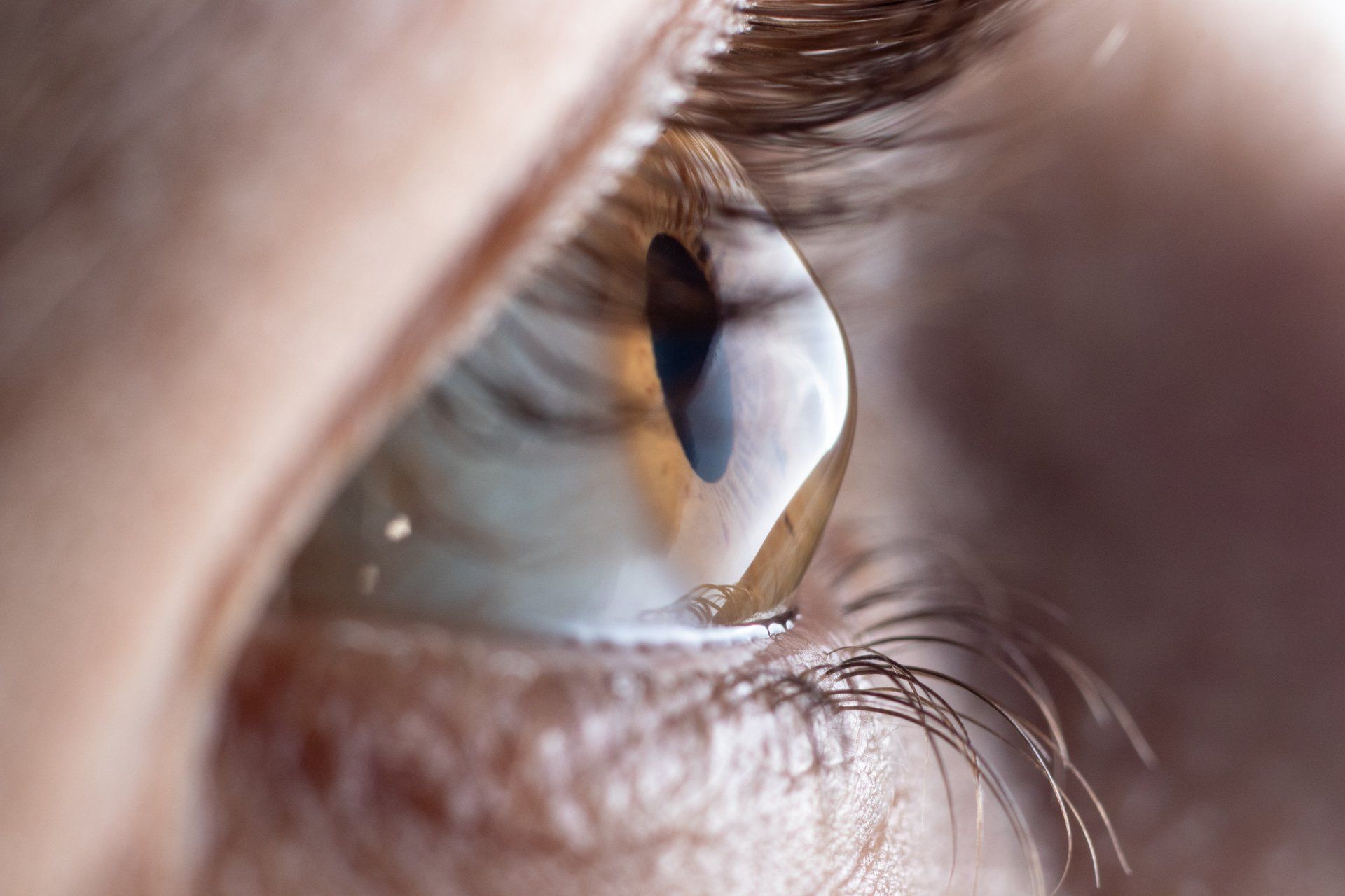 Ein typisches Auge mit Keratokonus bei der Kontaktlinsenanpassung