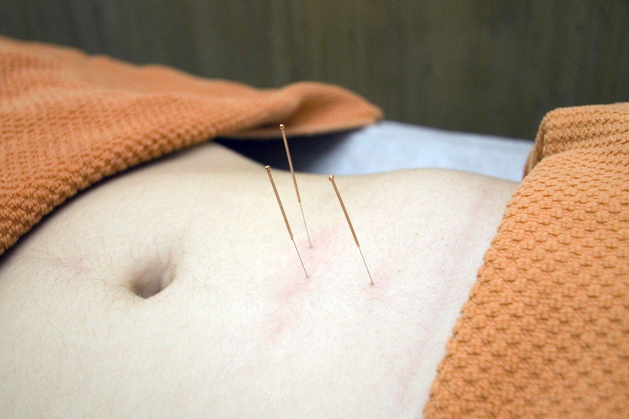 gezielte Akupunktur hilft, Rückenschmerzen zu lindern und vorzubeugen