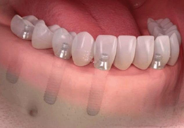 Dental implants in the lower jaw, showing the titanium posts and new teeth.