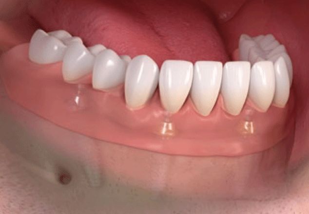 Close-up of an upper denture in a person's mouth. Pink gum-colored base with white teeth.