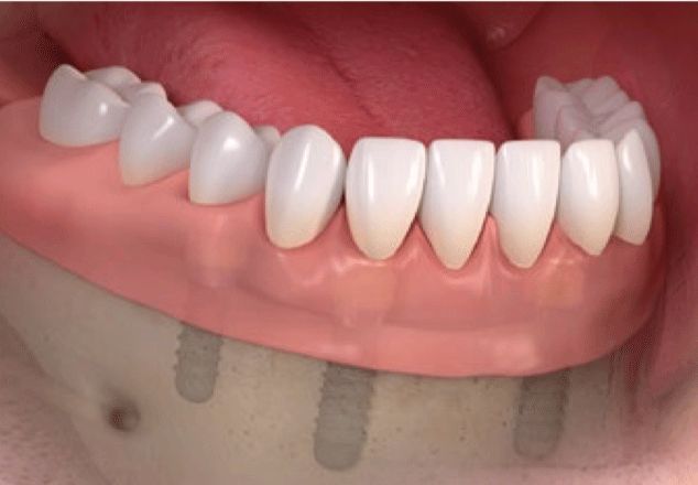 Dental implant denture in mouth; pink gums, white teeth, silver implants.