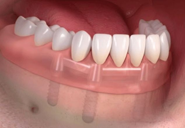 Close-up of lower teeth. A clear dental implant model over gums, with artificial teeth.