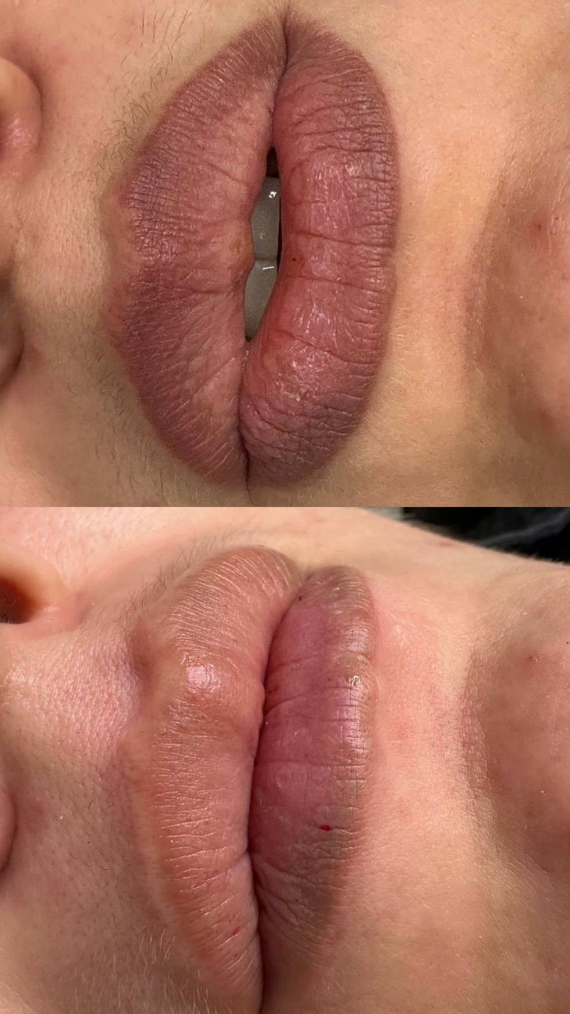 Two close-up views of lips. The top view shows chapped, dry lips slightly parted. The bottom view shows slightly glossy lips.