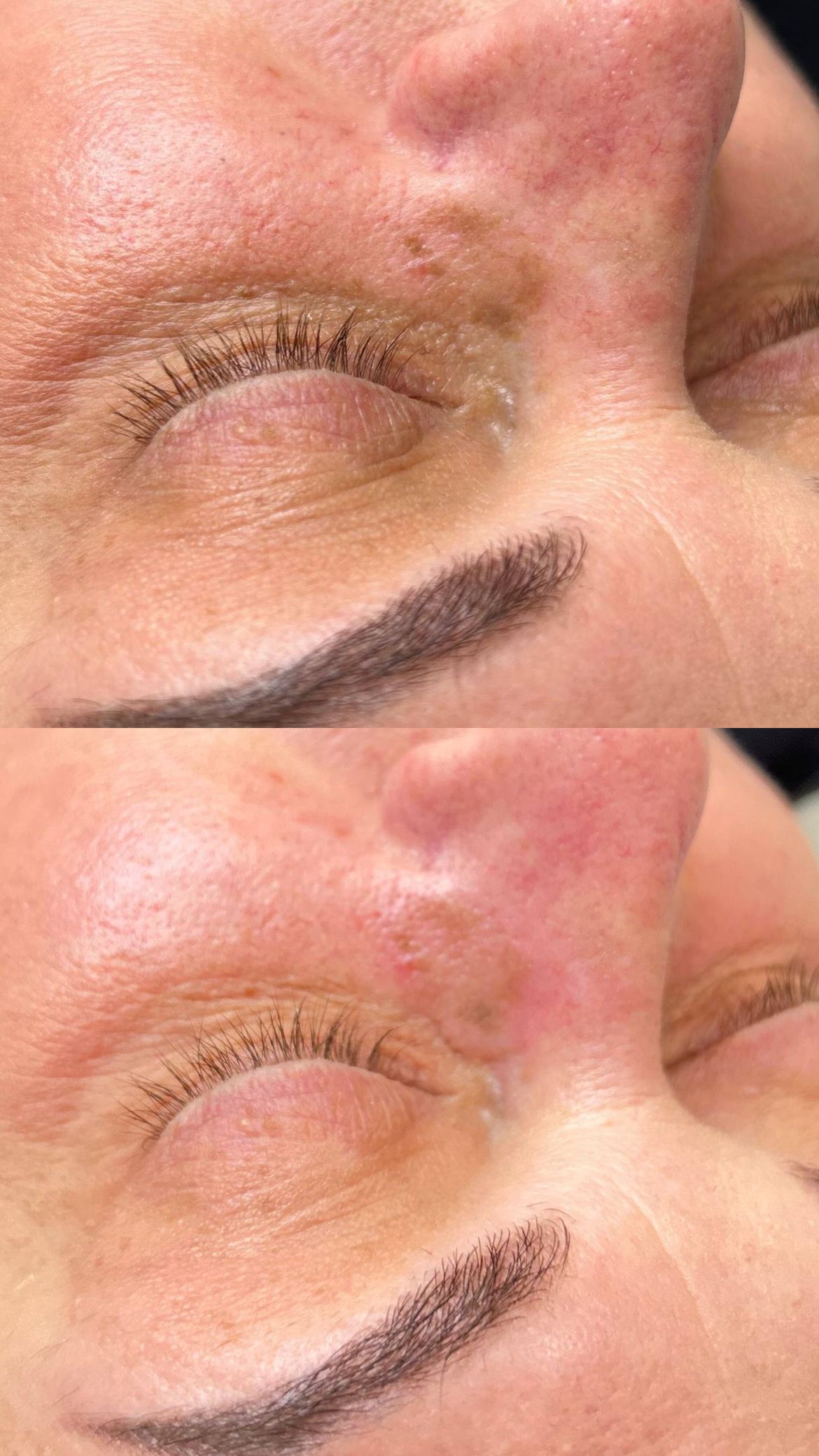 Two close-up views of a person's closed eyes, upper view shows peeling skin, lower view shows improved skin.
