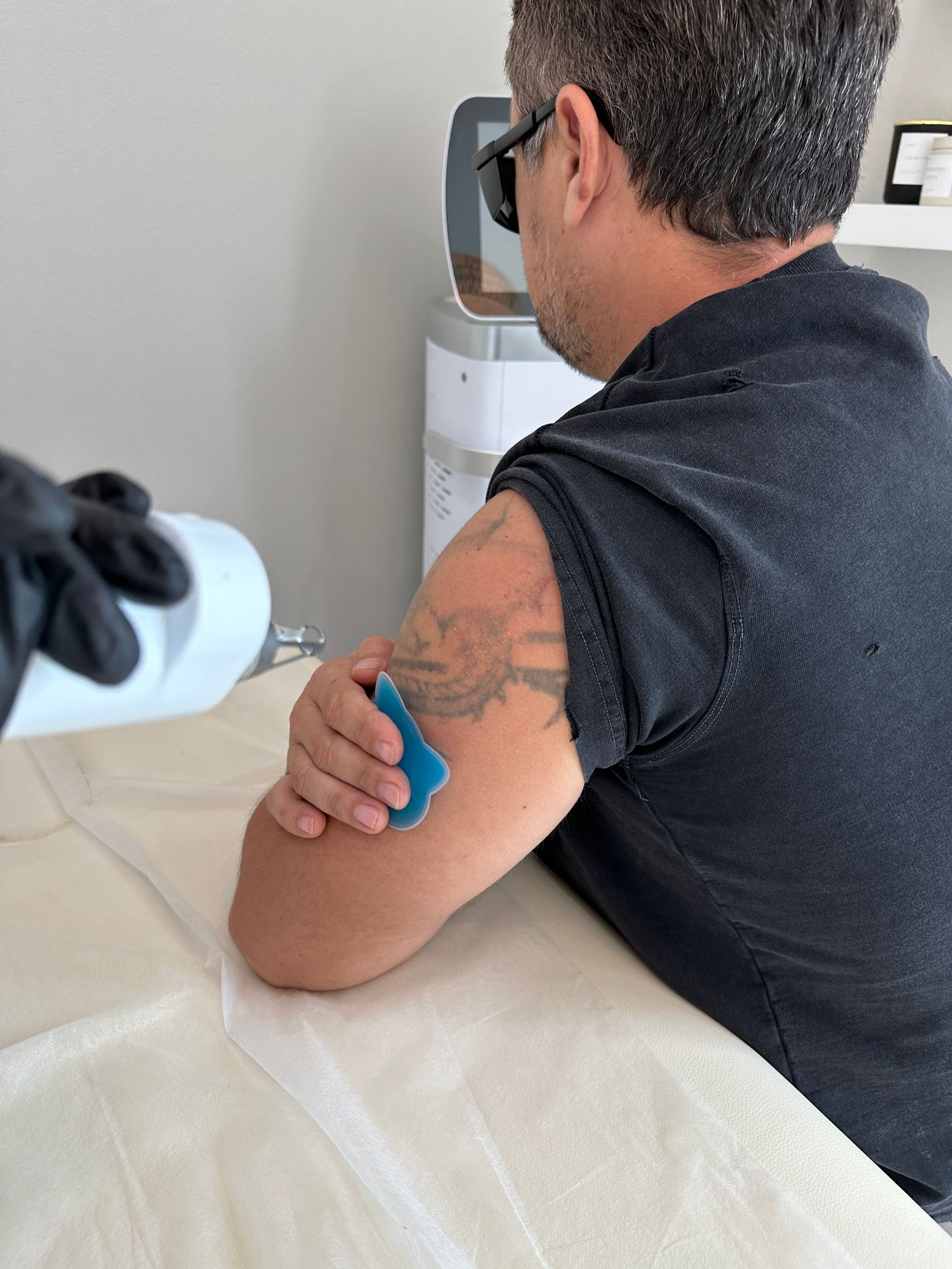 Person receiving laser tattoo removal on upper arm; holding blue ice pack. Black gloved hand holds laser device.
