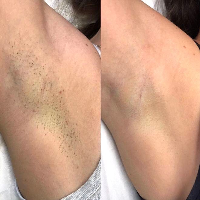 Before and after of armpit hair removal, showing less hair in the after image.